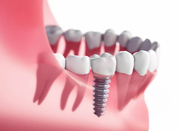 Zahnimplantat Kieferimplantat Implantat 3d Illustration