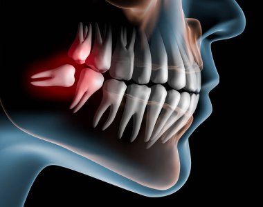 Zahnschmerz - Liefer mit liegendem Weisheitszahn - 3D illustration clipart