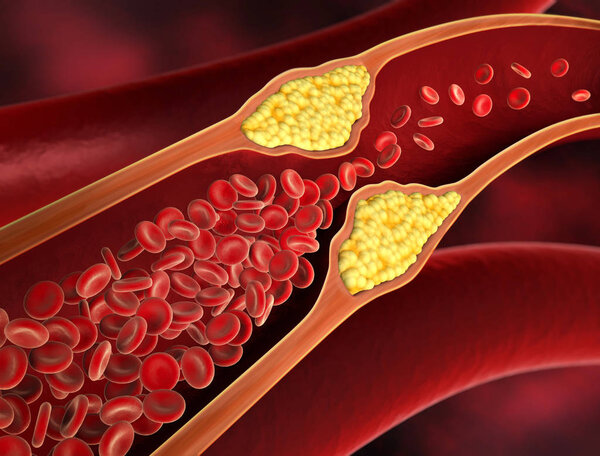 Red blood cells - narrowing of a blood vessel - Erythrozyt 3D illustration