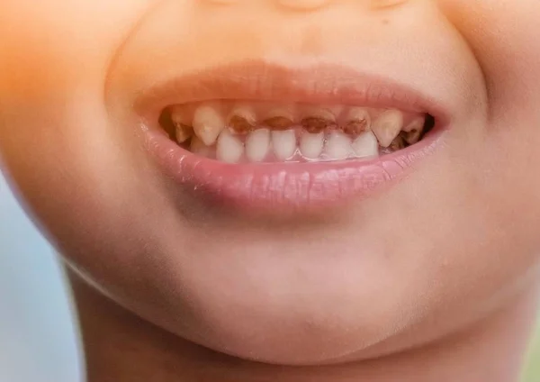 Asiático criança dente decadência — Fotografia de Stock
