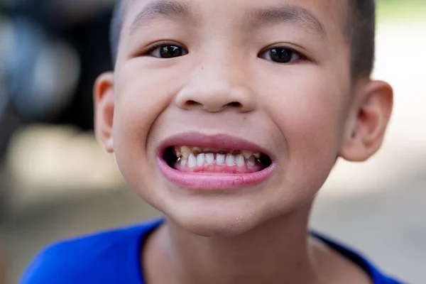 Een lachende Aziatische jongen en zag zijn tand vergaan — Stockfoto