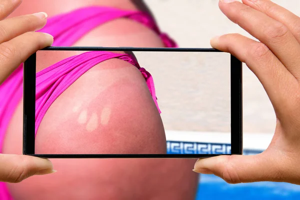 Donna Con Foto Del Telefono Cellulare Immagine Pelle Bruciata Sulle — Foto Stock