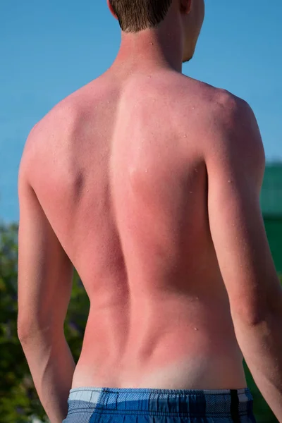 Male Back Burned Sun — Stock Photo, Image