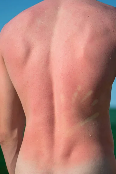 Male Back Burned Sun — Stock Photo, Image