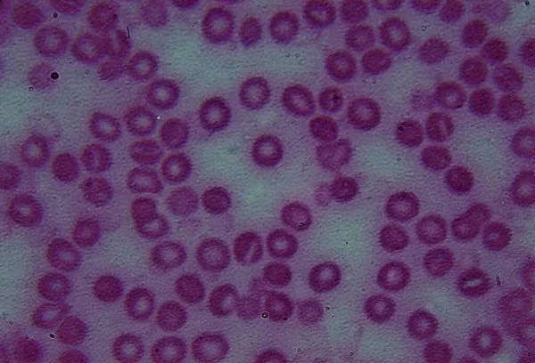 Esfregaço Sangue Humano Sob Microscópio Hemoglobina — Fotografia de Stock