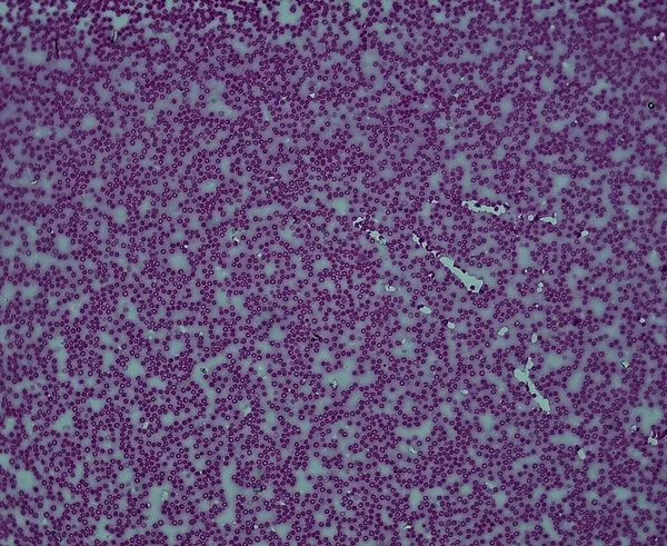 Esfregaço Sangue Humano Sob Microscópio Hemoglobina — Fotografia de Stock