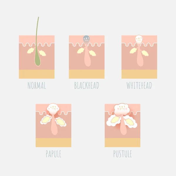 siyah kafa, whitehead, papül, püstül, düz karakter tasarımı, çizgi film infografik, vektör, illüstrasyon gibi akne cilt anatomisi ve türü