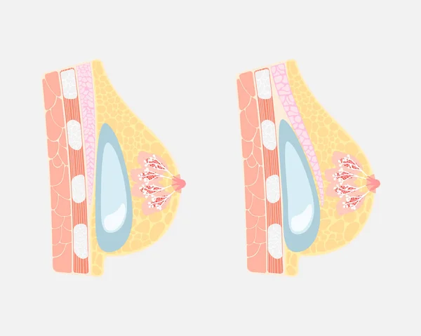 Implantation Chirurgie Silicone Seins Humains Sous Sur Pectoralis Muscle Mamelon — Image vectorielle
