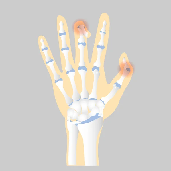 手の解剖学の骨 内臓の一部整形外科のヘルスケア トリガー指の概念 ベクターイラスト漫画フラットキャラクターデザインクリップアート — ストックベクタ