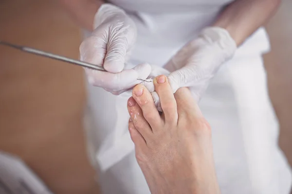 Profesionální Lékařská Pedikúra Zblízka Pomocí Dvouhřebíkového Nástroje Pacient Chiropodistického Podiatra — Stock fotografie