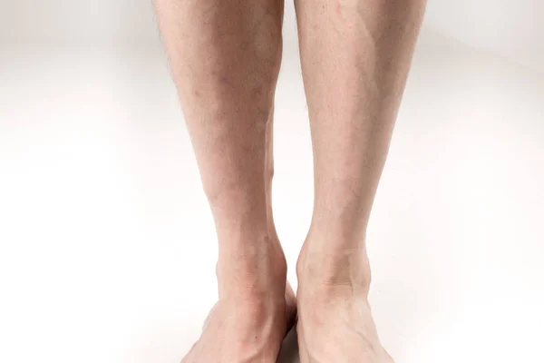 Naked legs of a man with varicose veins on a white background — Stock Photo, Image