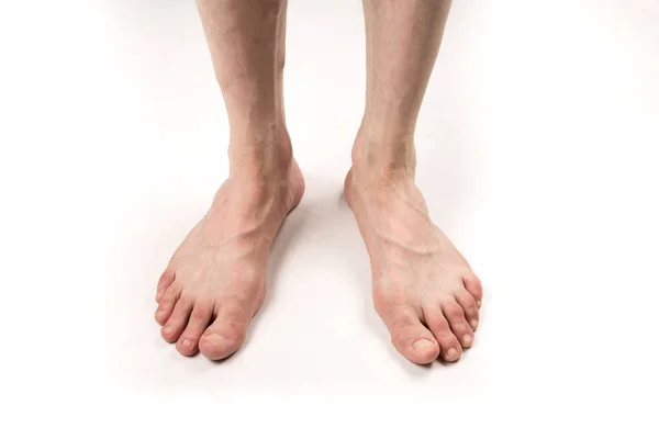 Pernas nuas de um homem com varizes em um fundo branco — Fotografia de Stock