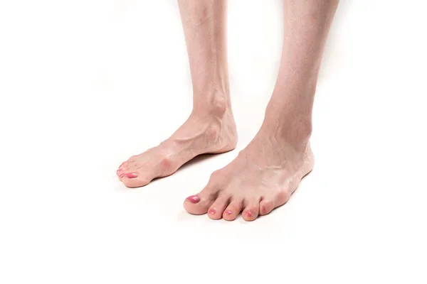 Female legs with transverse flat feet and protruding veins — Stock Photo, Image