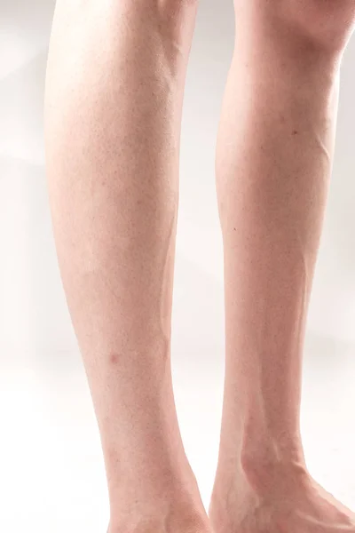 Piernas femeninas con pies transversales planos y venas sobresalientes —  Fotos de Stock
