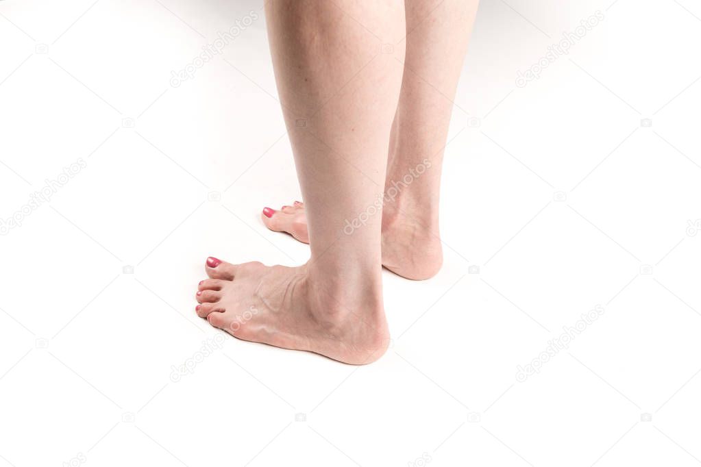 female legs with transverse flat feet and protruding veins