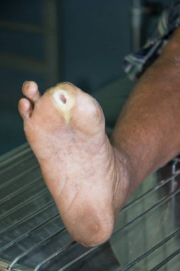 diyabetik ayak yarası 