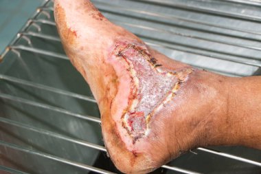 diyabetik ayak yarası 