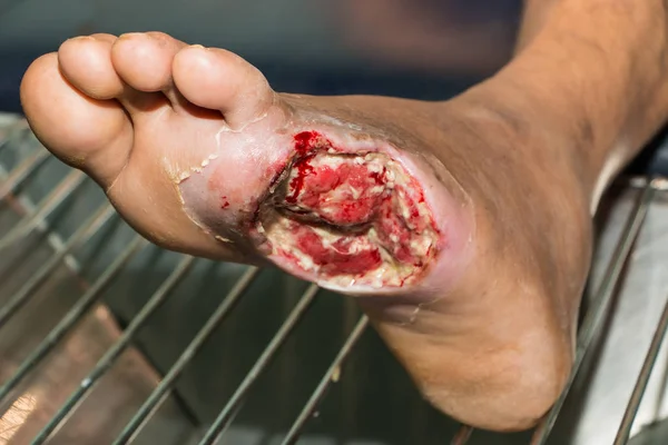 Wound of diabetic foot — Stock Photo, Image