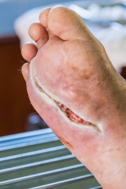 diyabetik ayak yarası