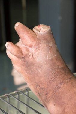 diyabetik ayak yarası