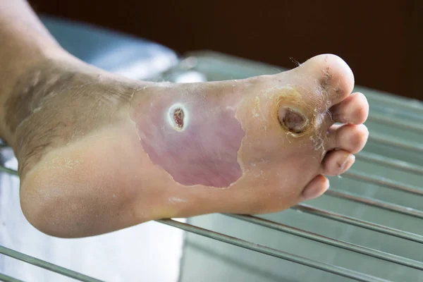 Wound of diabetic foot — Stock Photo, Image