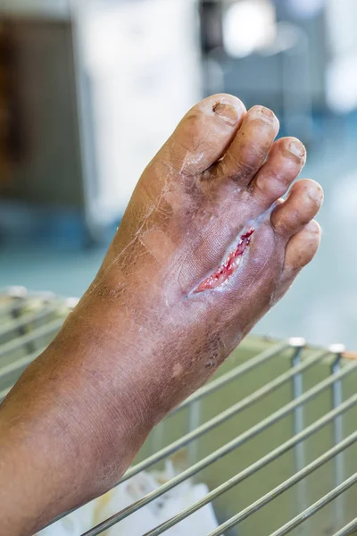 Wound of diabetic foot — Stock Photo, Image
