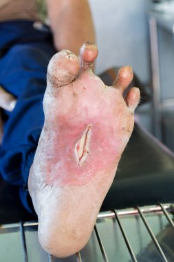 diyabetik ayak yarası