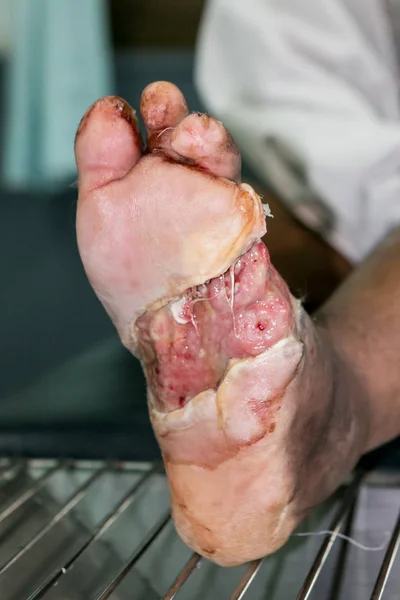 Herida del pie diabético — Foto de Stock