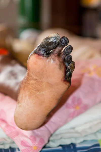 Wound of diabetic foot — Stock Photo, Image