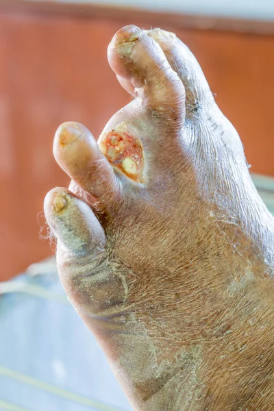 Herida del pie diabético — Foto de Stock