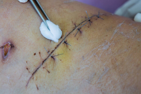 operation suture with a blue fiber at leg patient