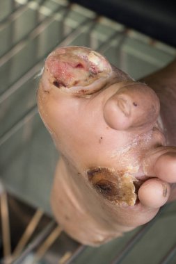 diyabetik ayak yarası