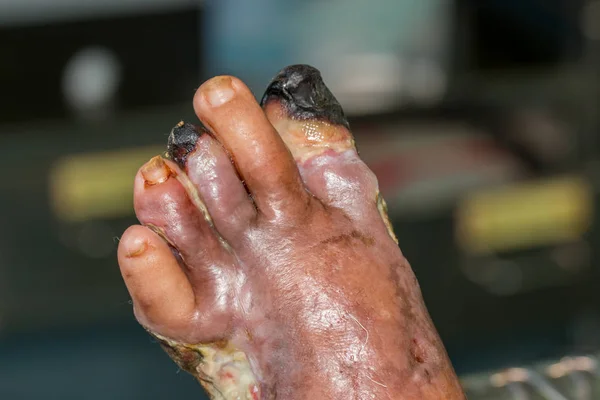 Herida del pie diabético —  Fotos de Stock