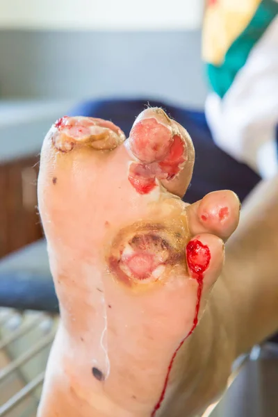 Herida infectada del pie diabético — Foto de Stock