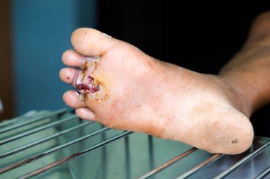 diyabetik ayak enfekte yara