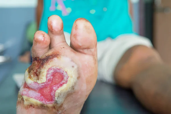 Infected wound of diabetic foot — Stock Photo, Image