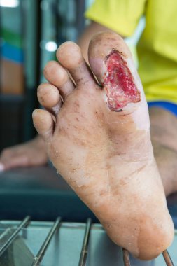 diyabetik ayak yarası