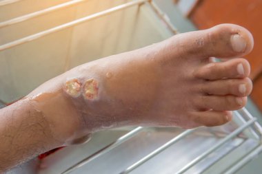 Diyabetayak ülserleri