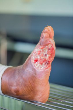 diyabetik ayak yarası