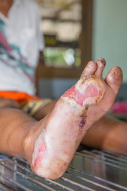 Diyabet ayak ülserleri , seçici odak.