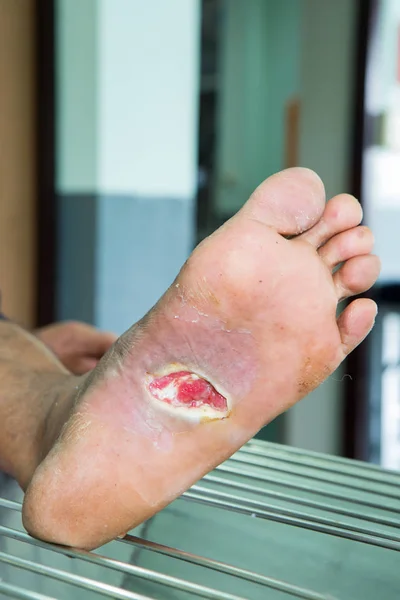 Wound of diabetic foot — Stock Photo, Image