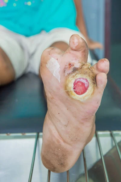 Ferida infectada do pé diabético — Fotografia de Stock