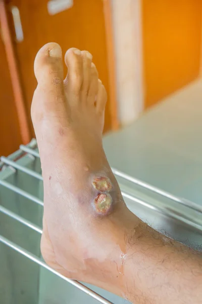 Úlceras nos pés por diabetes — Fotografia de Stock