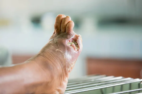 Ferida infectada do pé diabético — Fotografia de Stock