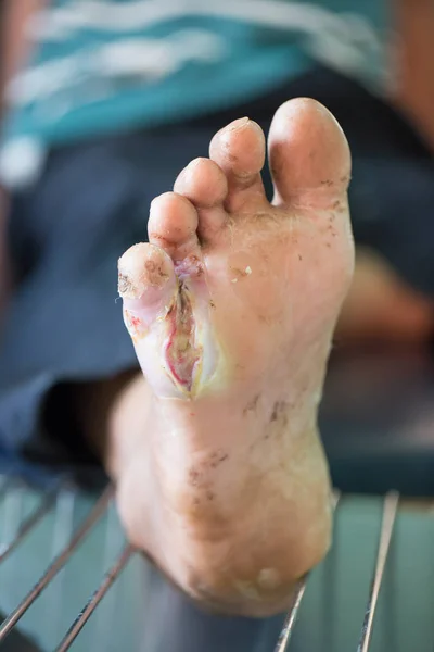 Úlceras en los pies por diabetes — Foto de Stock