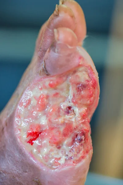 left great toe diabetic ulcer icd 10)