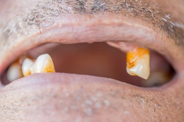 Çürüklerle açık ağız