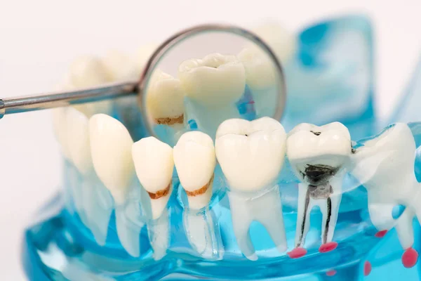 Objeto modelo dental com ferramenta odontológica — Fotografia de Stock
