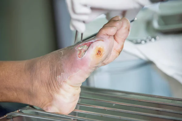 Infected wound of diabetic foot — Stock Photo, Image