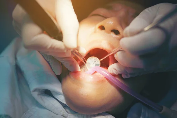 Закрыть стоматолога использовать инструмент заполнения кариозный зуб в стоматологической клинике — стоковое фото